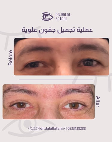 تجميل جفون علوية