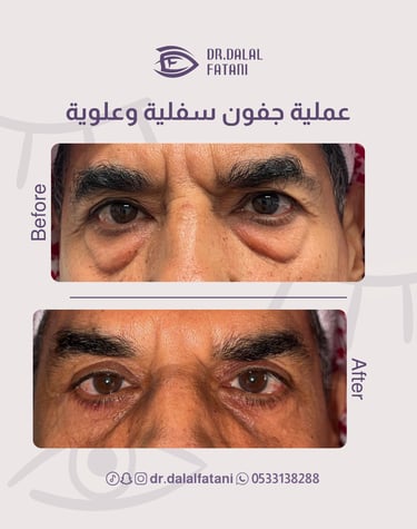 عملية جفون علوية وسفلية