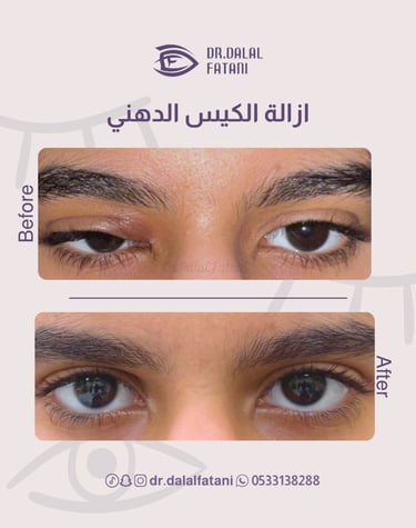 عملية ازالة كيس دهني من العين