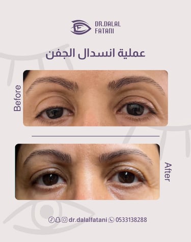 عملية انسدال الجفن