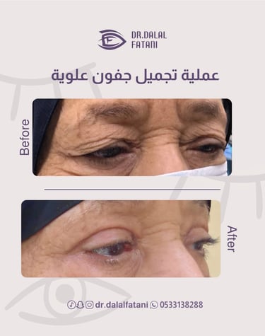عملية تجميل جفون علوية