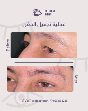 تجميل الجفن العلوي
