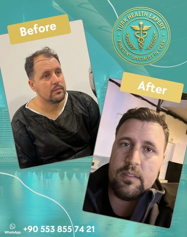 Foto of before and after hair transplant patient result