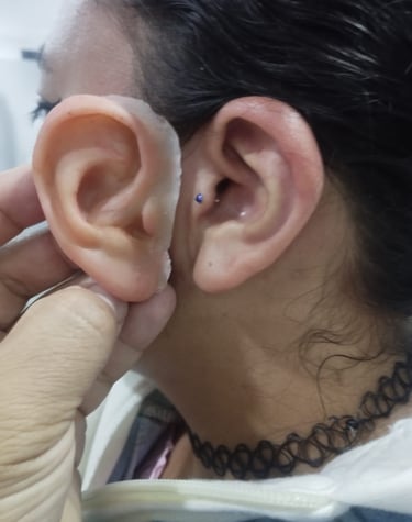protesis para Microtia, personas que no tienen orejas