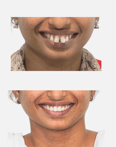 Smile Transformation