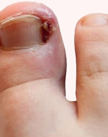 TRATAMENTO UNHA ENCRAVADA EM BH