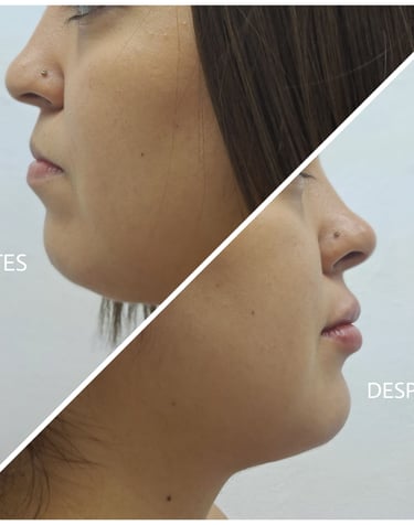 Fotografía de antes y después de una armonización facial que incluye relleno de labios, mentón y corrección de nariz