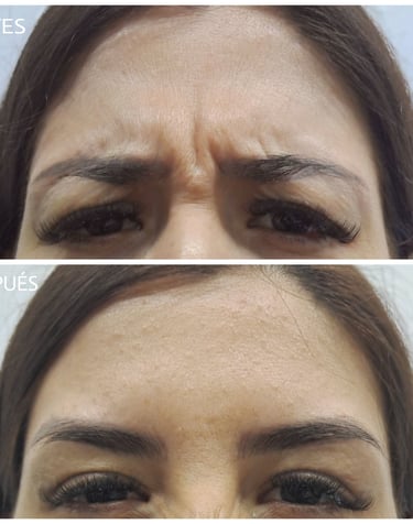 Fotografía de antes y después de tratamiento con toxina botulínica para eliminar las arrugas del entrecejo