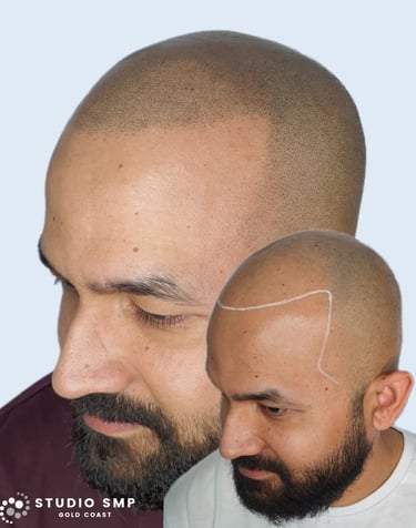 Scalp Micropigmentation (SMP)