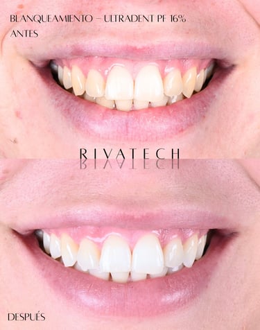 Before and after comparison of professional teeth whitening using Ultradent PF 16% gel.