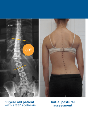 Scoliosis management, Precision center in Muscat