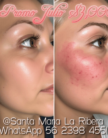 Tratamientos faciales y láser Belle Santa Maria la Ribera CDMX