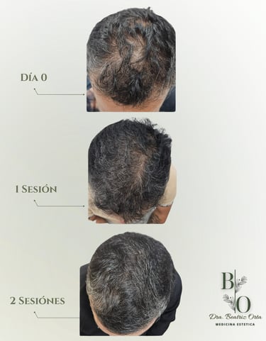 beneficios del tratamiento hydrafacial keravive reduce la caída del cabello y estimula el crecimient