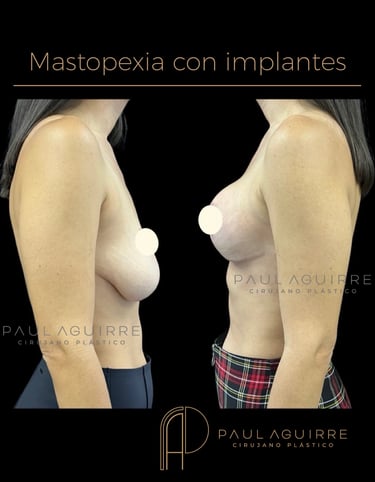 Cirujano plástico de senos Bogotá | Levantamiento con implantes