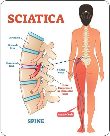 sciatica treatment Best chiropractor in Hyderabad