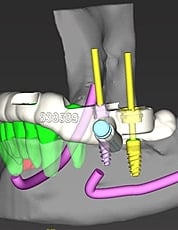 CBCT virtual planning