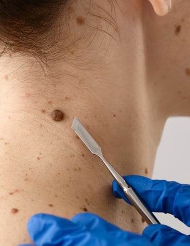 medicina estetica asportazione nei rovereto trento
