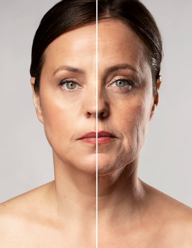 RF Microneedling comparison showing anti-aging treatment results on wrinkles and fine lines.