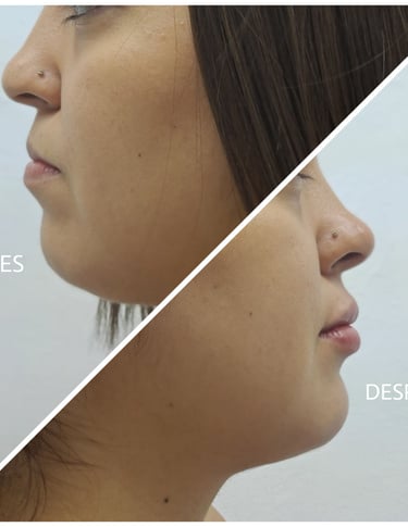 Fotografía de antes y después de una armonización facial que incluye relleno de labios, mentón y corrección de nariz