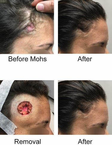 Mohs Surgery Before and After