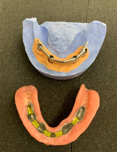sobredentadura sobre barra fresada