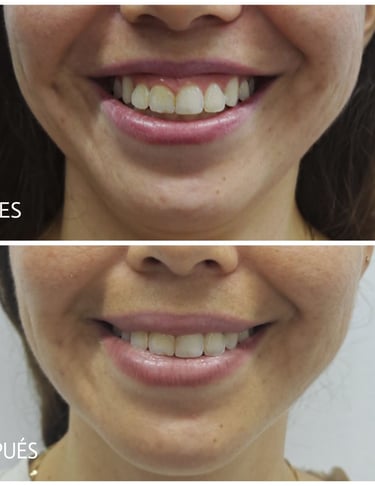 Imagen de antes y después del tratamiento con botox para corregir la sonrisa gingival