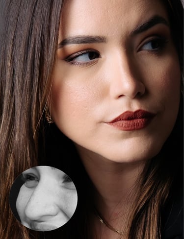 rinoplastia estruturada