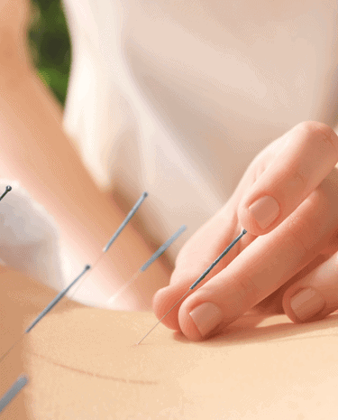 Applying acupuncture needles