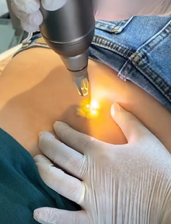 tatoeage verwijderen met picolaser amersfoort