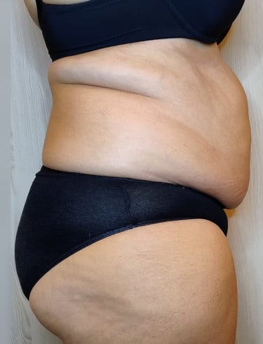 Fianchi e addome PRIMA del Trattamento Lipolite Corpo