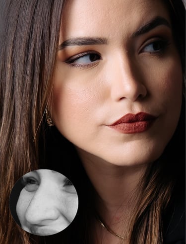 rinoplastia estruturada