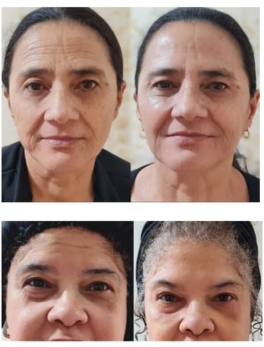 botox em bh