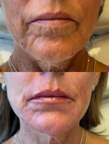 preenchimento labial viva clinica integrada estética avançada