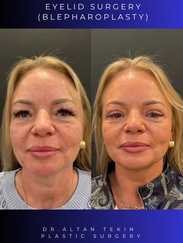eyelid surgery in Antalya
