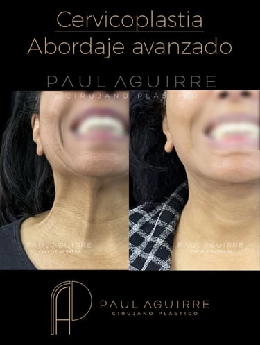 Cirujano plástico lifting cervicofacial Bogotá | Rejuvenecimiento facial