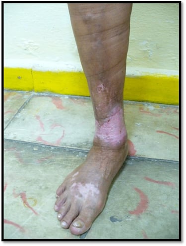 Despues del Tratamiento de Escleroterapia por el Dr. Antonio Suárez la ulcera cicatrizó