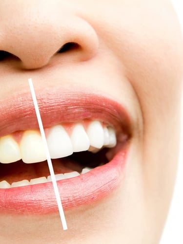portrait-photo-retouching-teeth-whitening