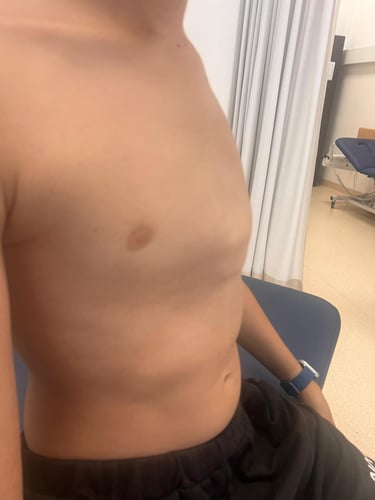 Pectus Carinatum expert specialist treatment