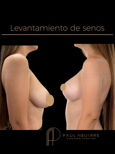 Cirujano plástico de senos Bogotá | Mastopexia