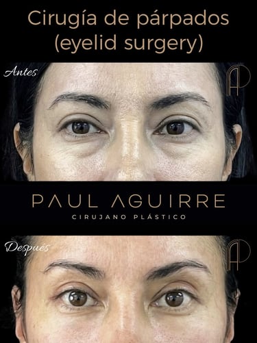 Cirujano plástico de párpados Bogotá | Blefaroplastia