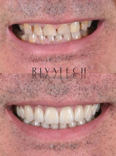 Carillas dentales de cerámica naturales, proporcion perfecta