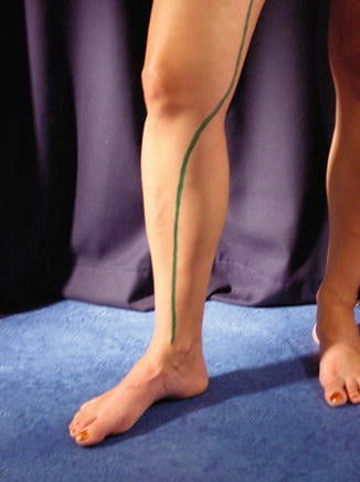 vascular ultrasound venous skin marking varicose veins surgery pre operative mapping vein skin imaging treatment leg swelling