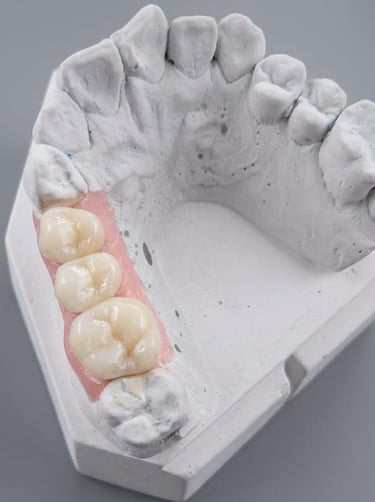 coronas posteriores de zirconia porcelana