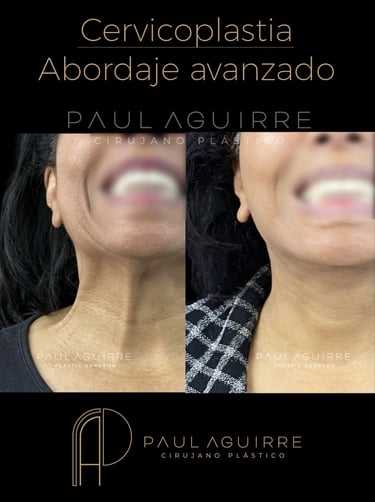 Cirujano plástico lifting cervicofacial Bogotá | Rejuvenecimiento facial