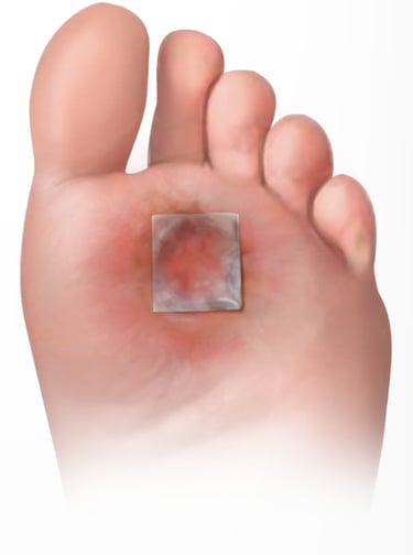 Restorigin amniotic membrane on a foot ulcer