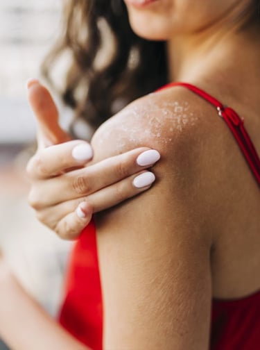 Dealing with Sunburns