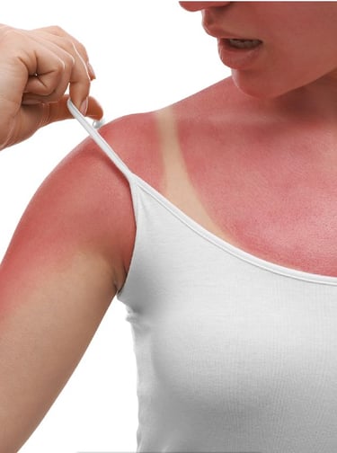 Dealing with Sunburns