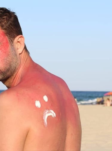 Dealing with Sunburns