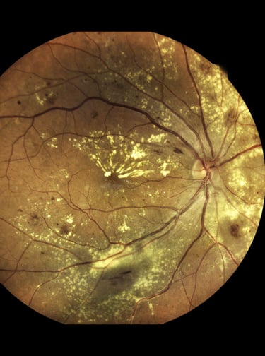 علاج اعتلال الشبكية السكري