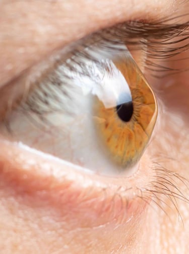 علاج القرنية المخروطية